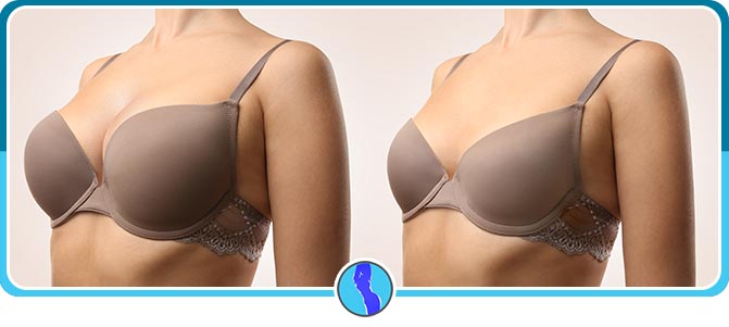 Benefits of Breast Reduction Near Me in Fairfax, VA Benefits of Breast Reduction Near Me in Fairfax, VA