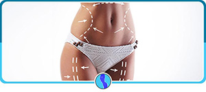 Liposuction Procedures Near Me in Fairfax, VA Liposuction Procedures Near Me in Fairfax, VA
