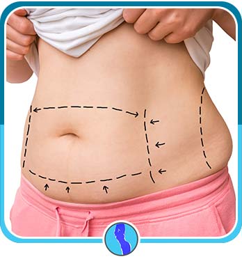 Tummy Tuck Near Me in Fairfax, VA