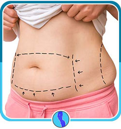 Tummy Tuck Near Me in Fairfax, VA