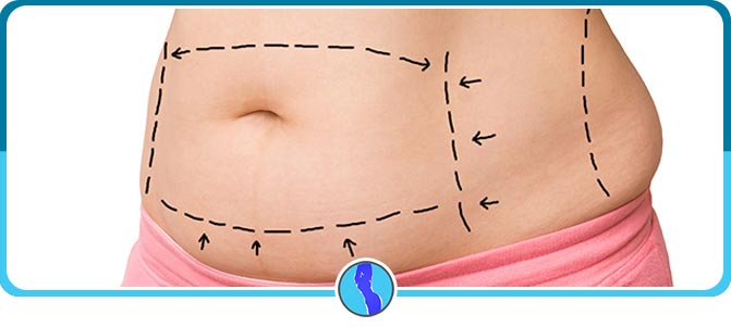 Tummy Tuck Austin Texas