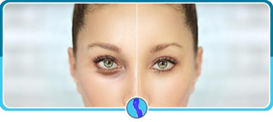 Upper and Lower Eyelid Surgery Near Me in Fairfax, VA Upper and Lower Eyelid Surgery Near Me in Fairfax, VA