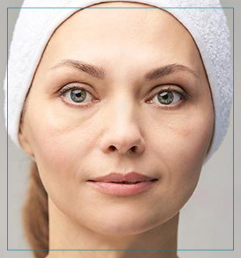 Eye Bag Removal Near Me in Fairfax, VA