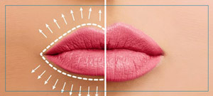 Lip Enhancement Treatment Near Me in Fairfax, VA