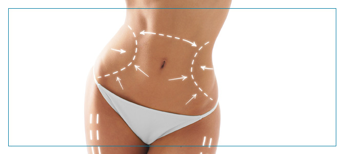 Liposuction Procedure Near Me in Fairfax, VA