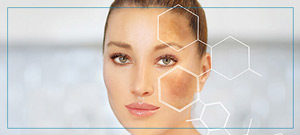 Melasma Treatment Near Me in Fairfax, VA