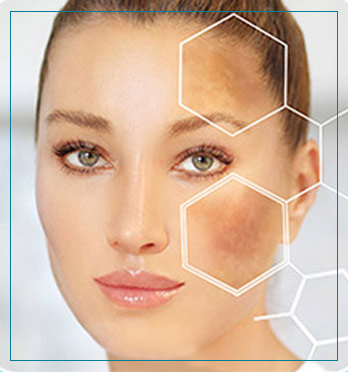 Melasma Treatment Near Me in Fairfax, VA