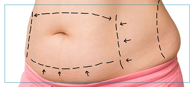 Mini Tummy Tuck Results  Cosmetic Plastic Surgery Institute