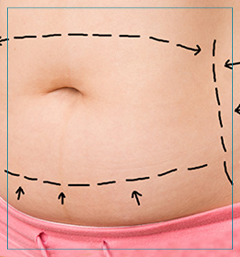 Tummy Tuck Full or Mini (Abdominoplasty) Surgery Near Me in Fairfax, VA