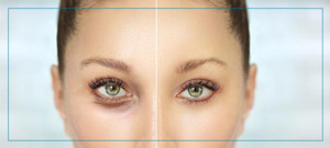 Upper and Lower Eyelid Surgery Near Me in Fairfax, VA