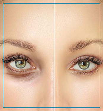 Upper and Lower Eyelid Surgery Near Me in Fairfax, VA