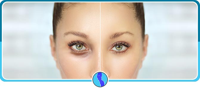Upper and Lower Eyelid Surgery Near Me in Fairfax VA Upper and Lower Eyelid Surgery Near Me in Fairfax VA